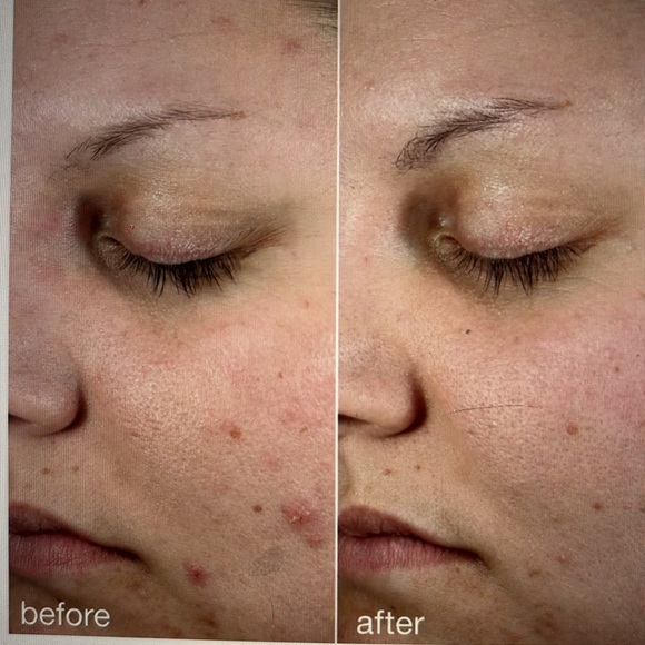 New Dermatológica Age Clearing Vegan Serum. 1 dl oz. 30 ml. New - Picture 7 of 7